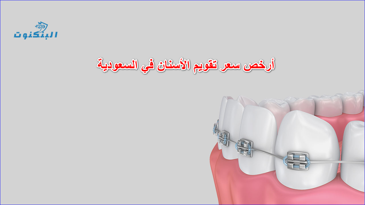 أرخص سعر تقويم الأسنان في السعودية