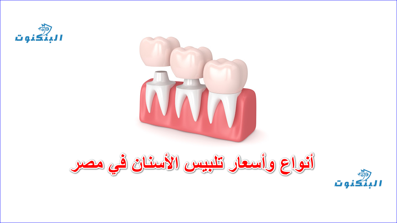 أسعار تلبيس الأسنان في مصر